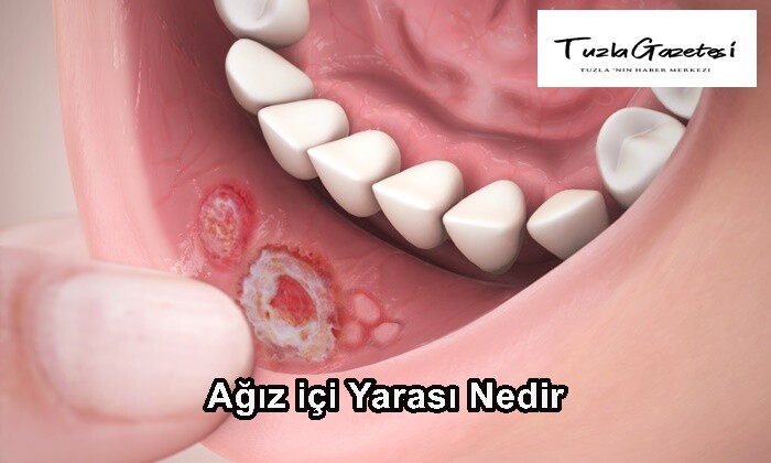 Ağız içi Yarası Nedir