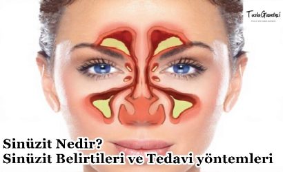 Sinüzit Nedir Sinüzit Belirtileri ve Tedavi yöntemleri