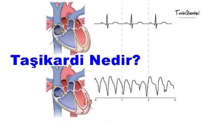 Taşikardi tedavisi Nedir