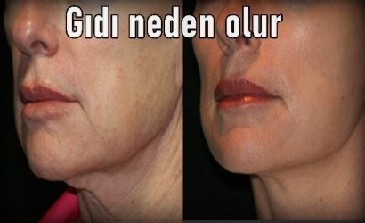 Gıdı neden olur tedavisi var mı