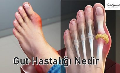 Gut Hastalığı tadavisi Nedir