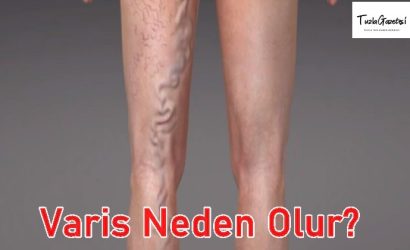 Varis Neden Olur tedavisi
