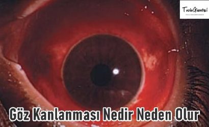 Göz Kanlanması sebebi Nedir Neden Olur