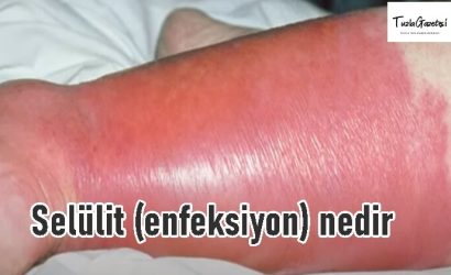 Selülit (enfeksiyon) nedir tedavisi