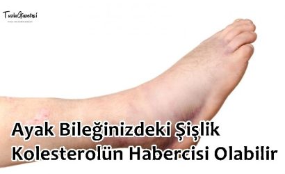 Ayak Bileğinizdeki Şişlik Kolesterolün Habercisi Olabilir