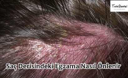 Saç Derisindeki Egzama Nasıl Önlenir