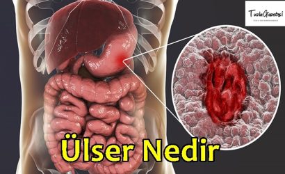 Ülser belirtileri Nedir