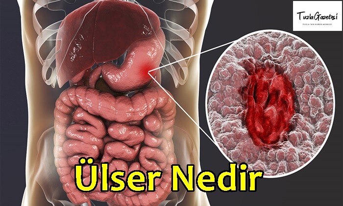 Ülser Nedir