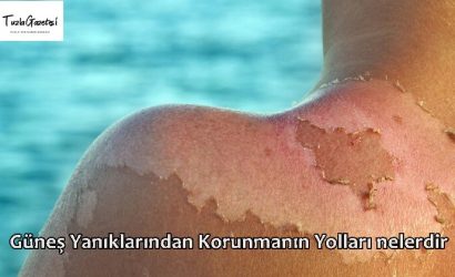 Güneş Yanıklarından Korunmanın Yolları nelerdir