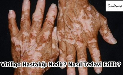 Vitiligo Hastalığı Nedir Nasıl Tedavi Edilir
