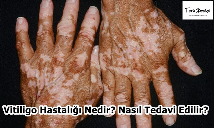 Vitiligo Hastalığı Nedir? Nasıl Tedavi Edilir?