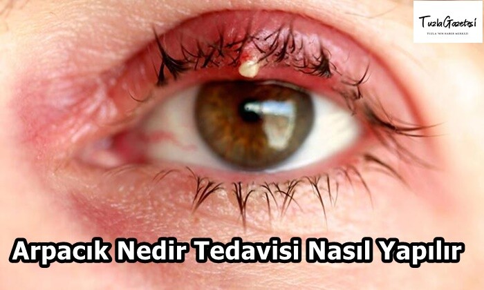 Arpacık Nedir Tedavisi Nasıl Yapılır