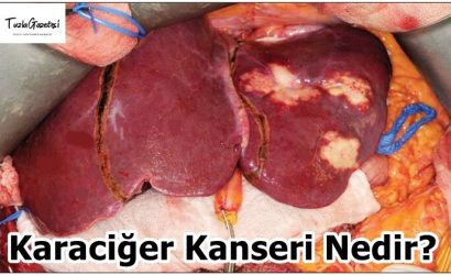 Karaciğer Kanseri Nedir?