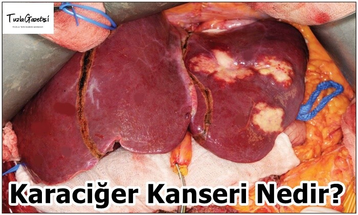 Karaciğer Kanseri Nedir?