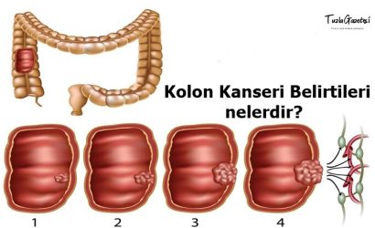 Kolon Kanseri Belirtileri nedir