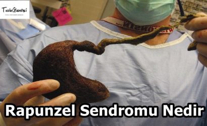 Rapunzel Sendromu nedenleri Nedir