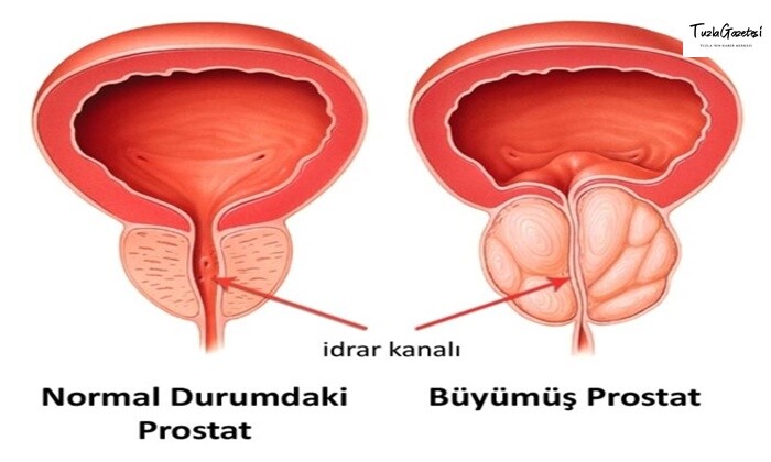 Antidepresan Kullanmak Prostat Kanserinin İlerleyişini Durduruyor Mu