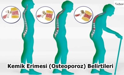 Kemik Erimesi (Osteoporoz) Belirtileri