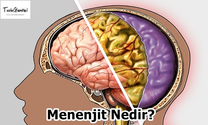 Menenjit Nedir