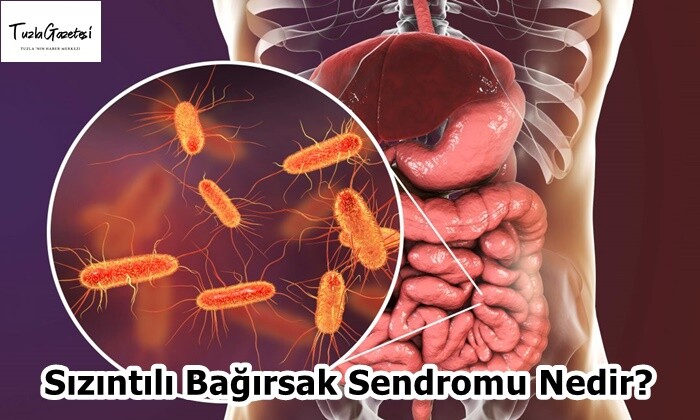 Sızıntılı Bağırsak Sendromu Nedir?