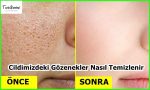 Cildimizdeki Gözenekler Nasıl Temizlenir