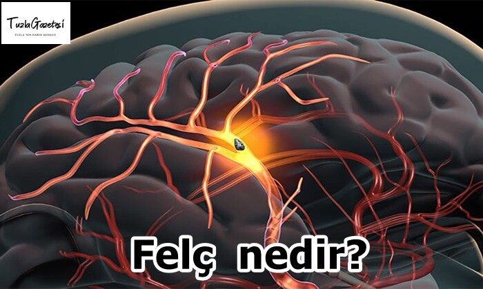 Felç nedir?