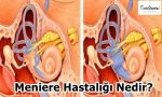 Meniere Hastalığı Nedir