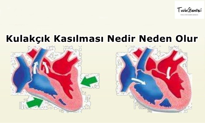 Kulakçık Kasılması Nedir Neden Olur? 