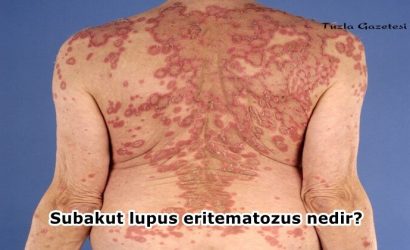 Subakut lupus eritematozus nedir