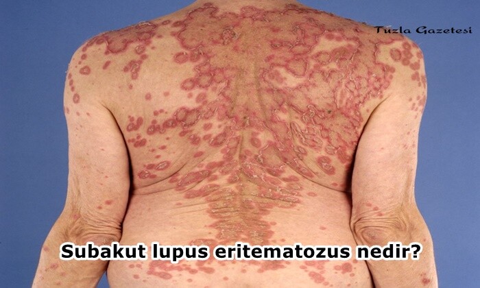 Subakut lupus eritematozus nedir