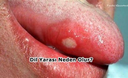 Dil Yarası Neden Olur